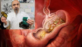 Un brócoli, sal marina y 250 ml de agua; remedio para eliminar el Helicobacter Pylori revelado por médico japonés