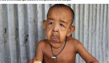 Benjamin Button: La tragedia de un niño de 4 años que tiene aspecto de anciano