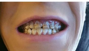 Joven británico perdió su dentadura tras ingerir bebidas energizantes