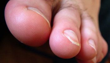  Tratamiento casero para uñas encarnadas