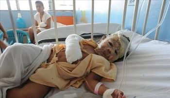 Dos niñas resultan con quemaduras al incendiarse su casa en Cabarete