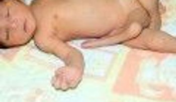 Nace bebe con seis piernas en Pakistán