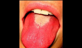10 enfermedades que puedes adquirir con un beso