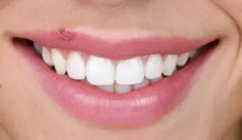 Cómo evitar y tratar el herpes labial