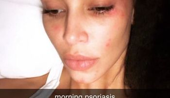 Kim Kardashian deja al descubierto marcas en su piel por enfermedad incurable 