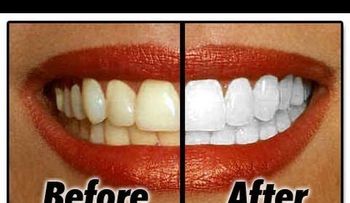 Para blanquear tus dientes en minutos 