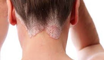 Alteraciones metabólicas: Comorbilidades más frecuentes de la psoriasis