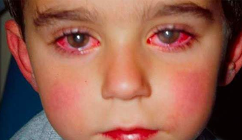 Este niño perdió el 75% de su vista por un juguete que había en la casa