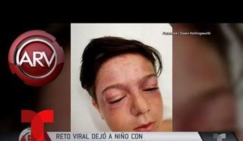 Un niño queda con lesiones cerebrales tras someterse a peligroso reto viral