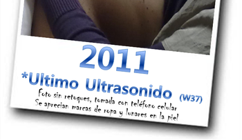 El secreto para eliminar y prevenir estrias !! ATENCION!!!