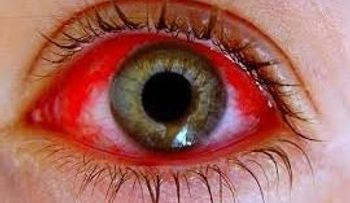 Atribuyen a las lluvias, brote de conjuntivitis afecta el país; muchos niños y adultos afectados 