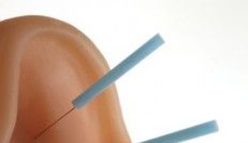 Aplicarte agujas en la oreja para perder peso: la famosa Auriculoterapia