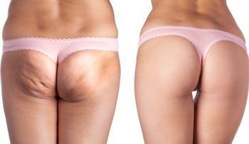 Exfoliante de café y azúcar, vinagre de manzana, miel y otros tratamientos contra la celulitis