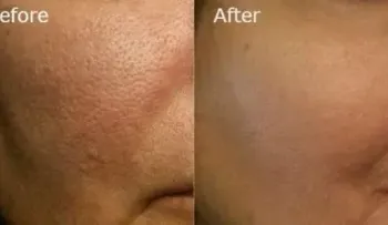 Formas naturales para remover los grandes poros 