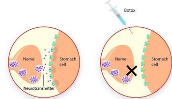 El bótox podría frenar la progresión del cáncer de estómago