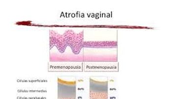La atrofia vaginal provoca sequedad e inflamación: Causas y síntomas