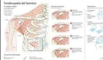 Si te duele el hombro puede ser por artritis o tendinitis 
