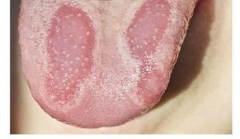 El misterioso trastorno que afecta a la lengua