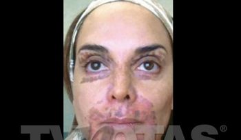 Lupita Jones quedó con la cara paralizada tras tratamiento estético