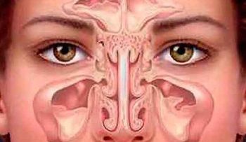 Para limpiar la Sinusitis: ingredientes 1 cebolla y 6 rábanos