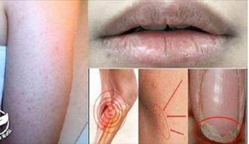 Si está perdiendo cabello, descubre la vitamina que te hace falta