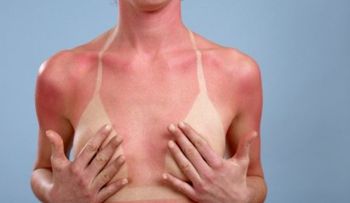 Quemaduras de sol provocan aparición de melanoma