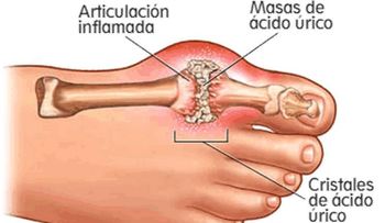 Artritis gotosa: causas, síntomas y tratamiento