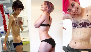 Una joven muestra en fotos cómo se recupera de la anorexia: "Se puede volver a ser feliz"