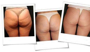 Cómo evitar la celulitis en las piernas