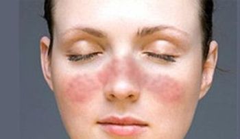 Alterar la microbiota de los enfermos de lupus mejora su respuesta inmune 