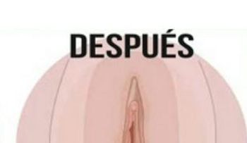 Este es el remedio más eficaz que una cirugía para estrechar la vagina