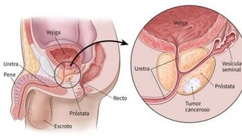 Estas 5 señales podrían advertir cáncer de próstata