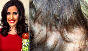 Una mujer se quedó CALVA luego de usar este famoso SHAMPOO!