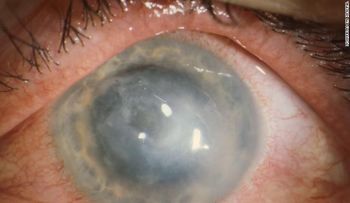 Alerta por aumento casos de una rara infección en los ojos por usar lentes de contacto