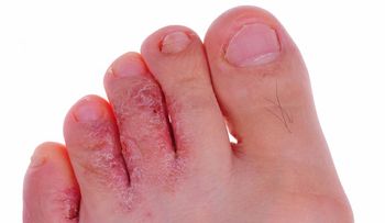 Vinagre de manzana para disminuir los hongos en la uñas y los callos de los pies