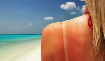 ¿Se te pasó la mano con el sol? Aquí tienes la solución