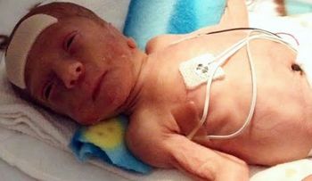 Conmovedor video del primer año de un bebé prematuro que pesó solo 700 gramos