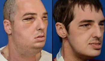 El hombre que encontró un rostro por un milagro médico, dice que se siente "normal" 