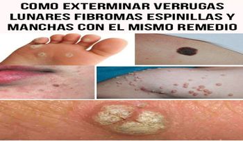 De esta manera podrás exterminar verrugas, lunares, fibromas, espinillas y manchas con el mismo remedio