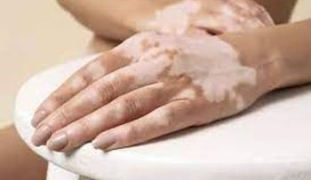 Revelan tratamiento para el vitiligo, Melagenina Plus, desarrollado en Cuba