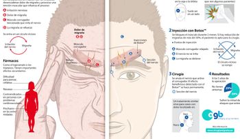 Un nuevo tratamiento para combatir la migraña con cirugía (VIDEO)