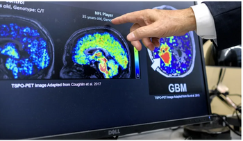 Latinos en EE.UU. hallan biomarcador contra Alzheimer