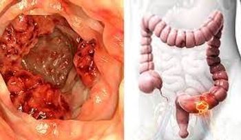 Este aceite destruye el 90% células del cáncer de colon en 3 dí­as, según demostración científica
