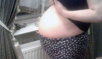 Una mujer tuvo 3 años su abdomen inflamado; parecía un embarazo