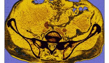 Amiloidosis, una enfermedad rara que deteriora los órganos vitales