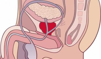 Los sintomas de una prostata enferma