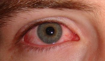 El cloro y el sol, principales enemigos de los ojos en verano
