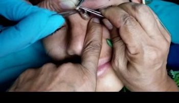 Conozca estos parásitos en el ano, y otros casos asquerosos 