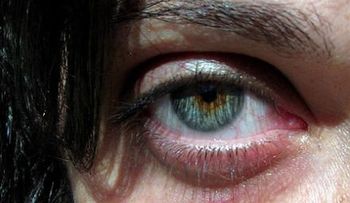 Ojeras: sus causas y cómo prevenirlas
