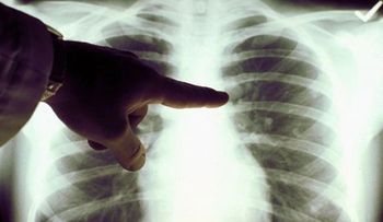 Un estudio revelará claves de la incidencia del cáncer entre hispanos de EEUU